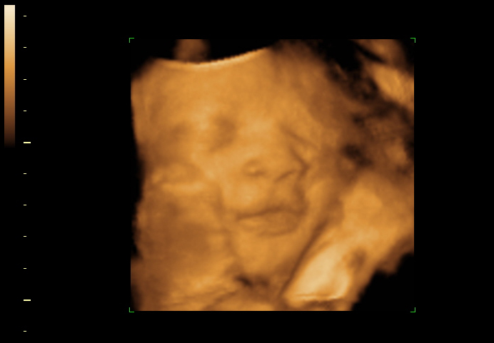3D ultrasound image at 34 weeks
